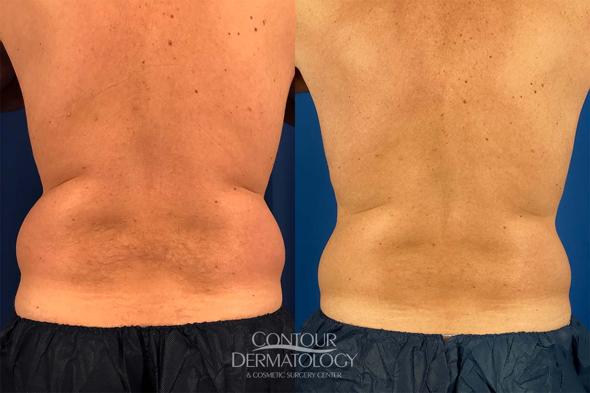 CoolSculpting Fat Freezing Flanks