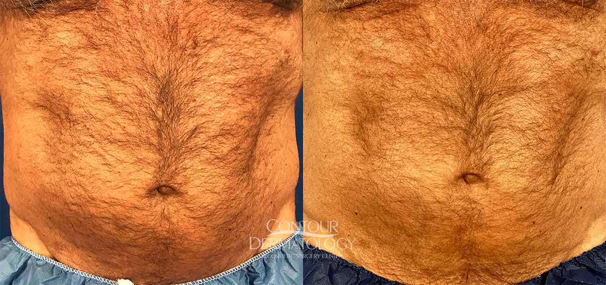 CoolSculpting - Upper & Lower Flanks Before & After Gallery - Case 4437