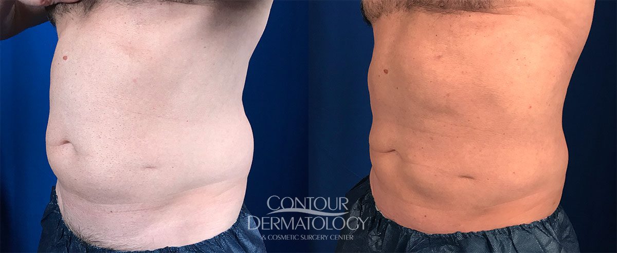 CoolSculpting - Upper & Lower Flanks Before & After Gallery - Case 4437