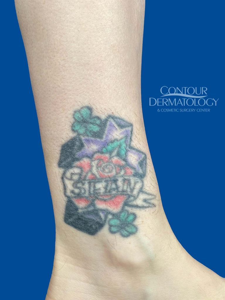 laser hair removal hair growth on tattoo