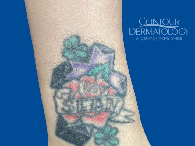 laser hair removal hair growth on tattoo