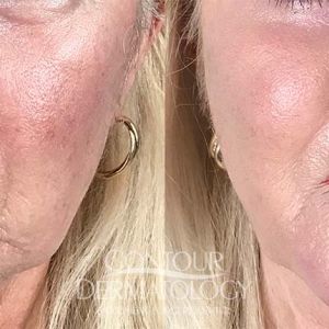 Fractional Co2 4mL Restylane Defyne Cheeks, 3 mL Restylane Defyne Lips and Marionette, Kybella Jowls