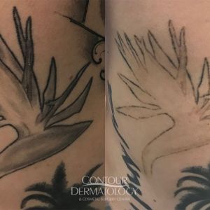 Tattoo removal 6 treatments