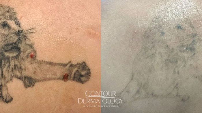 Picoway Tattoo Removal 1 treatment