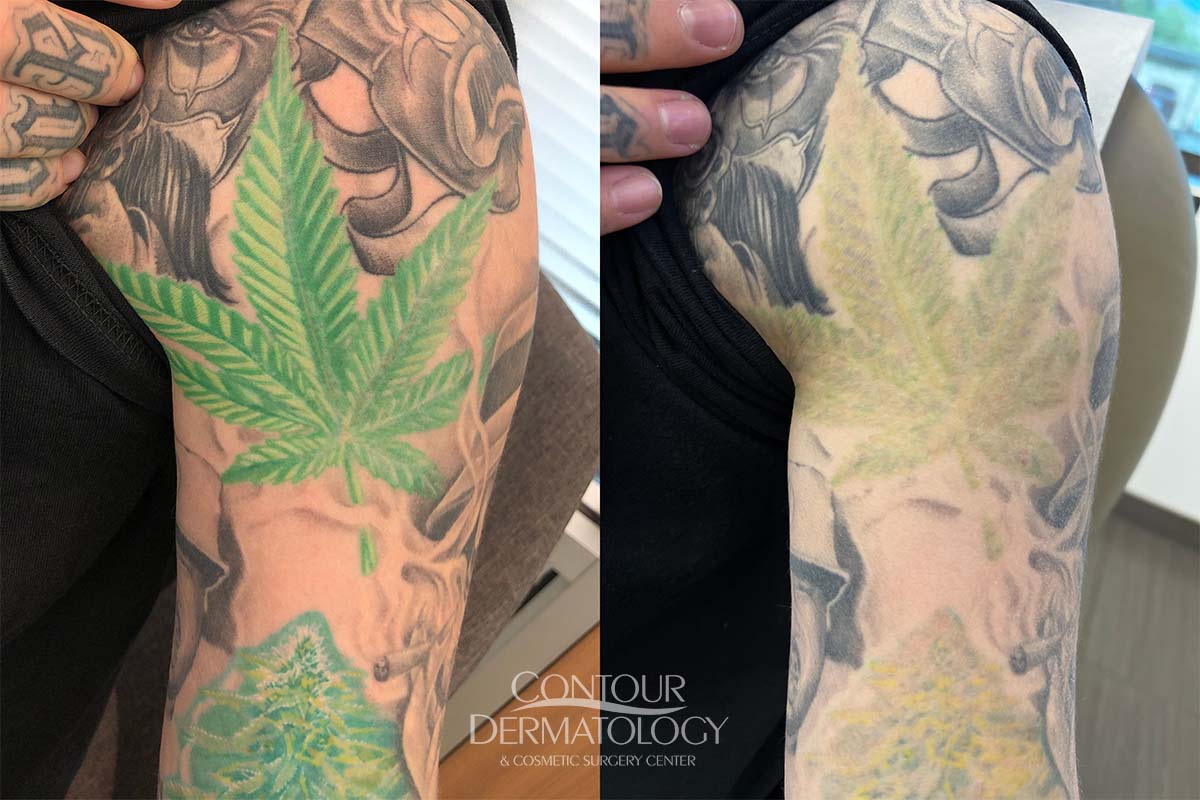 PicoWay Tattoo Removal Before and After Photos
