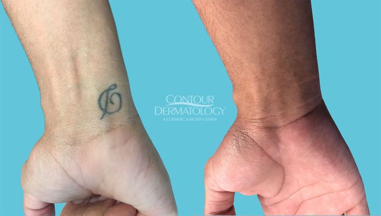 Picoway Tattoo 4 treatments