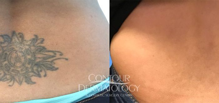 Picoway Tattoo 3 treatments