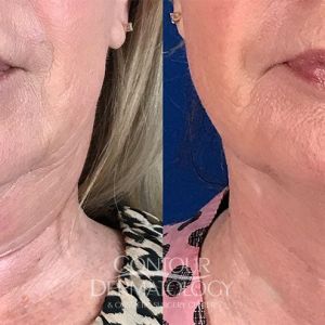 Kybella for Jowls