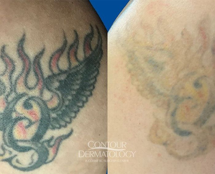 Pico Tattoo removal 2 treatments