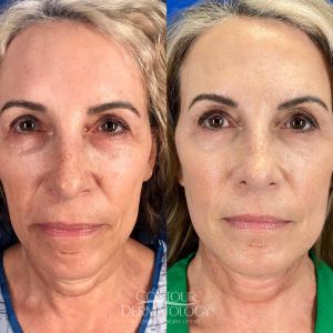 Mini Face Lift, before and after, 58 year old woman