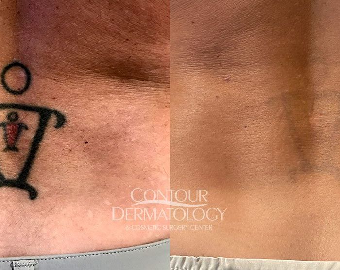 Tattoo Removal 6 treatments