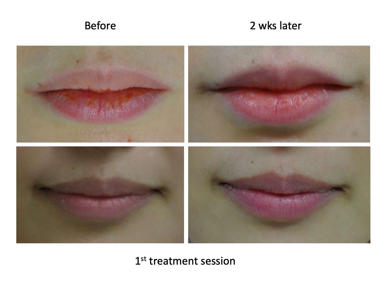 Our erbium Laser does more than give lip service. It offers lip rejuvenation in two ways – it can rejuvenate the texture of your lips and restore lip color.