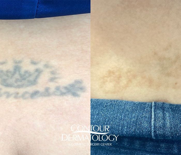 Picoway Tattoo Removal, 2 Treatments, 39-yr-old Female