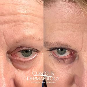 Lower Eyelid with Fractional Co2, 60-yr-old, Female