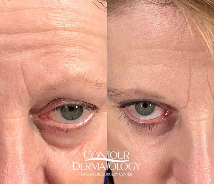 Lower Eyelid with Fractional Co2, 60-yr-old, Female