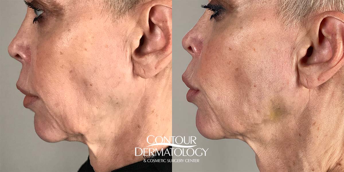 Juvéderm Volux Before and after, Jawline, 62 year old woman.