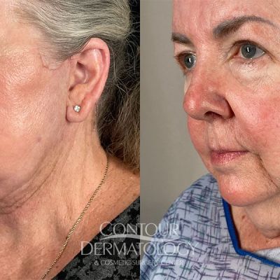 Mini Face Lift Female 68-years