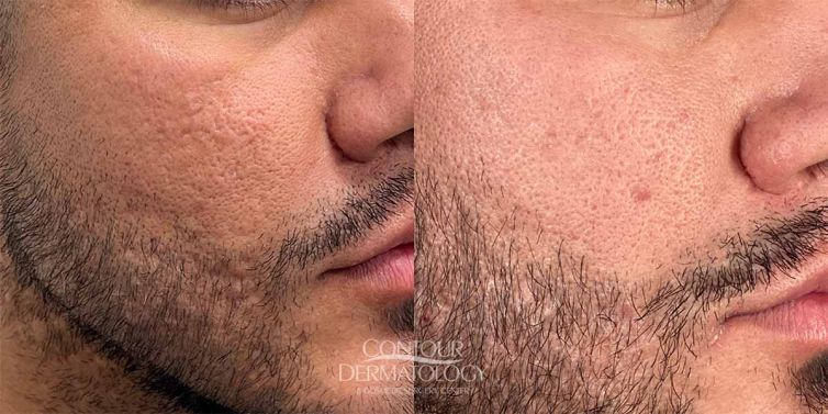 Fractional Co2, Acne Scaring