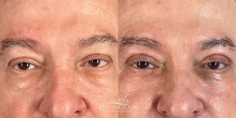 Fractional Co2 with Blepharoplasty Upper and Lower