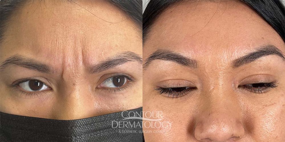 Botox on Glabella, 33-years old Female