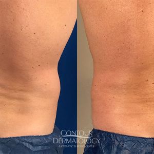 Flanks Liposuction  Before and After Photos - Palm Clinic