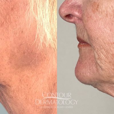 Mini Facelift, 64-years old Female