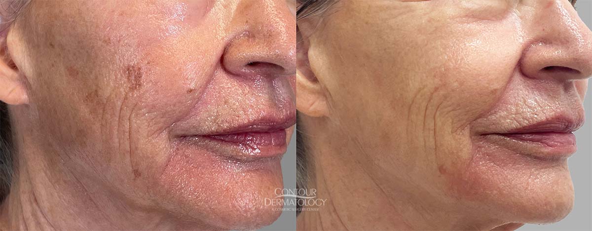 Erbium laser, plus IPL one treatment.