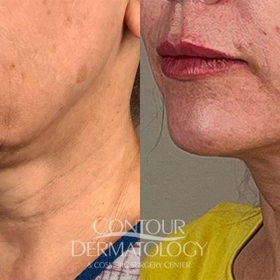 Mini face lift woman age 54