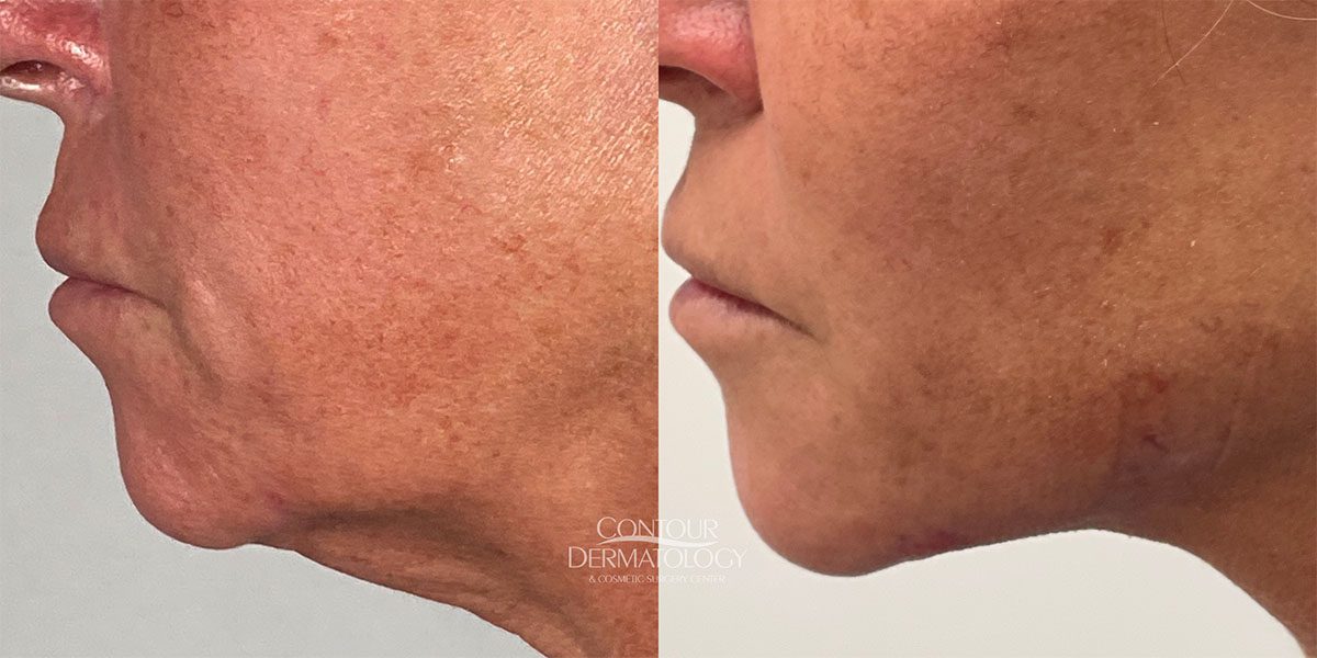 Face liposculpture before and after, 50-year-old woman