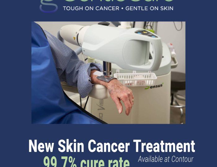 Surgery isn’t the only option for treating your skin cancer. GentleCure Image-Guided SRT is a surgery-free treatment for basal and squamous cell skin cancers.