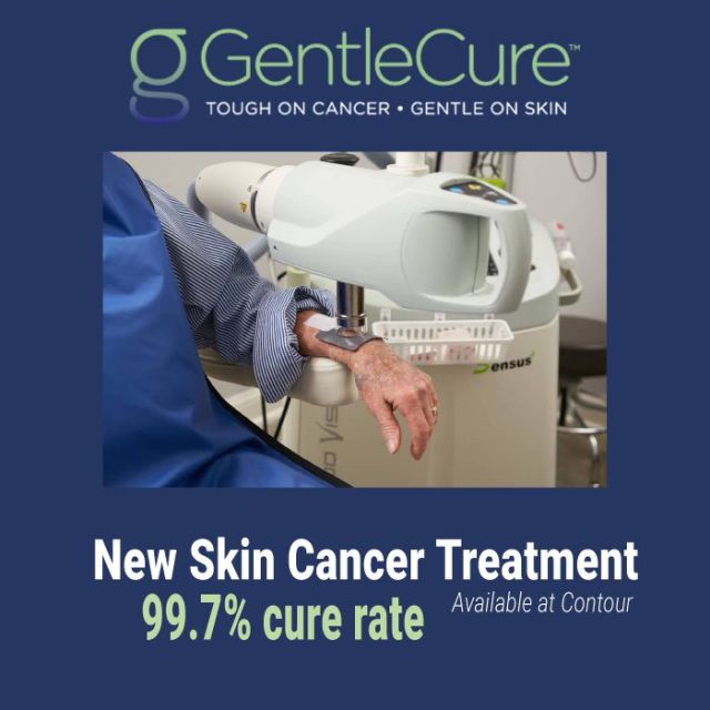 Surgery isn’t the only option for treating your skin cancer. GentleCure Image-Guided SRT is a surgery-free treatment for basal and squamous cell skin cancers.