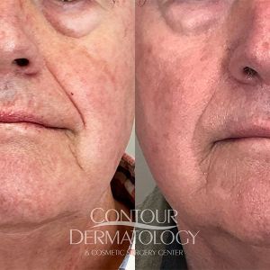IPL for face male 82 years old