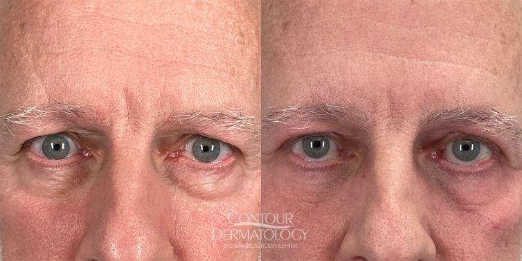 Upper and Lower Eyelid Surgery, 65 Male