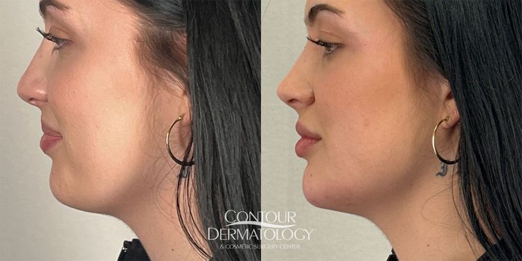 1ml Restylane Contour to Chin, 20-year-old woman