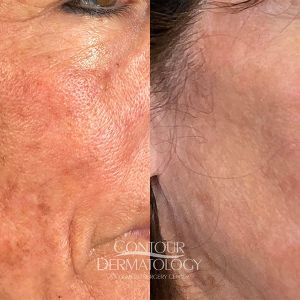 IPL for Face Female 57 years old