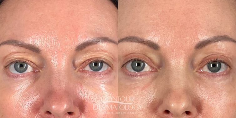Upper and Lower Eyelid Surgery, 51 Female