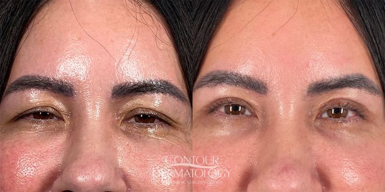 Upper Eyelid Surgery, 65-years old