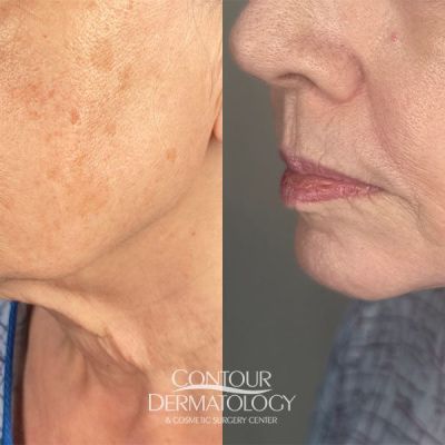 Mini FaceLift, 61-year old, Female