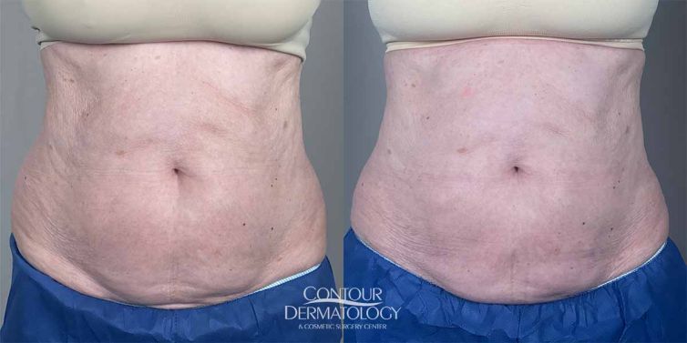 CoolSculpting Abdomen, 79-year Old, Female 3 Sessions of CoolSculpting to Abdomen