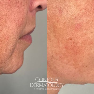 MiniFace Lift, 68-Year Old, Female