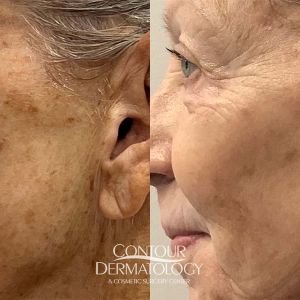 IPL for Face, 67-years old, Female