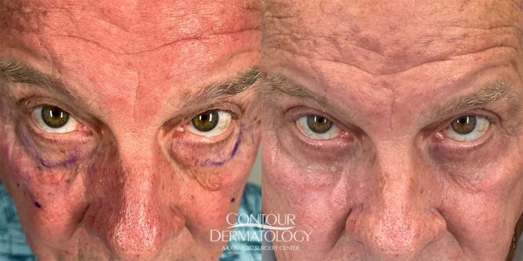 Lower Eyelid Surgery with Co2, 74-Year old, Male