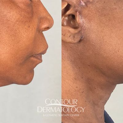 Mini Facelift, 66-year-old Female