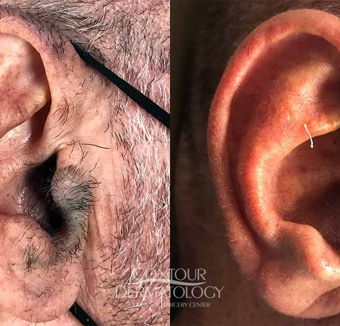 Laser hair removal ears, 71 year-old man