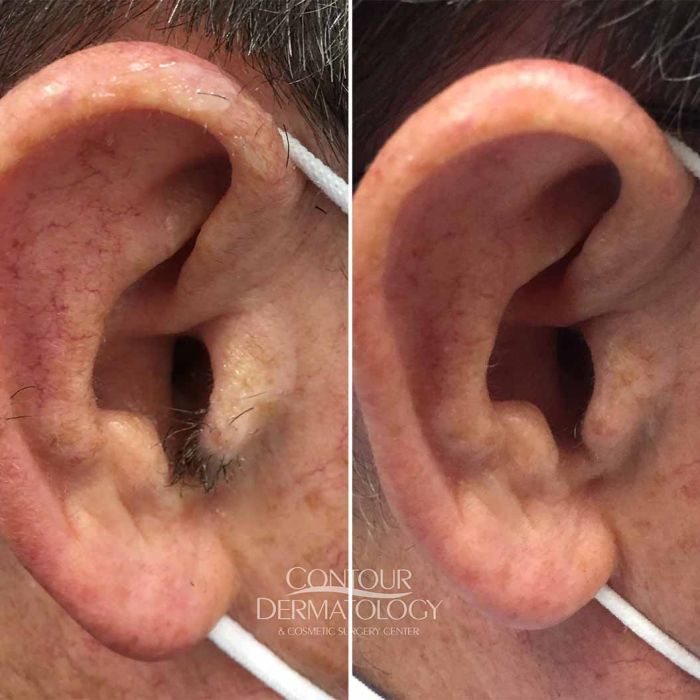 Laser hair removal ears, 73 year-old man