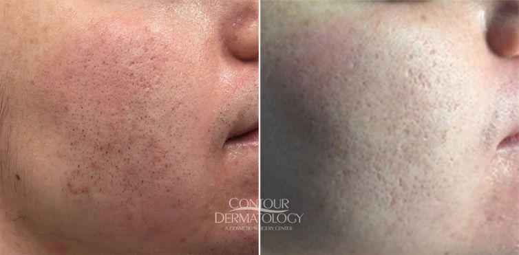 Laser hair removal face, 24 year-old woman