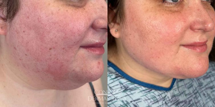 Chin liposculpture before and after photo