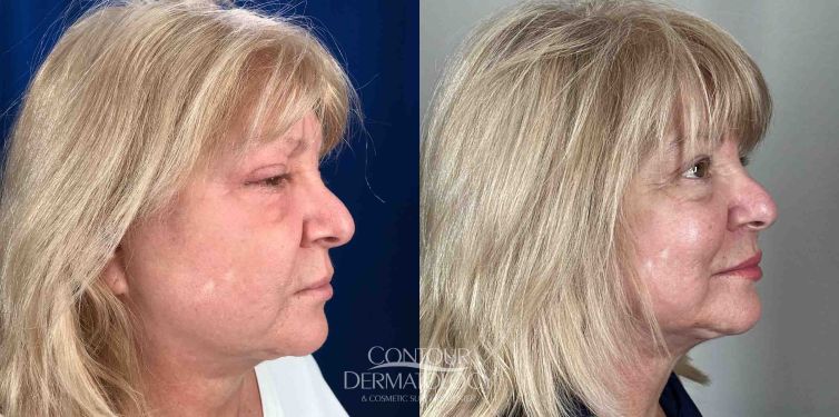 Kybella injection treatment for double chin (submental fullness).