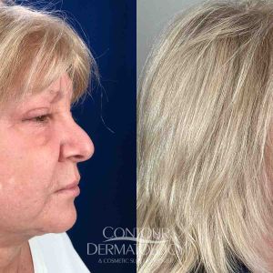 Kybella injection treatment for double chin (submental fullness).