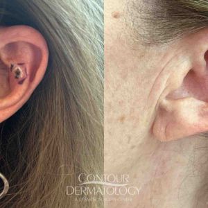 Mohs surgery for left ear.